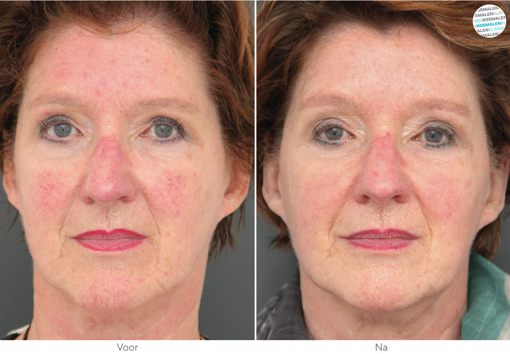 Laserbehandeling rosacea voor en na foto Van Rosmalen Kliniek