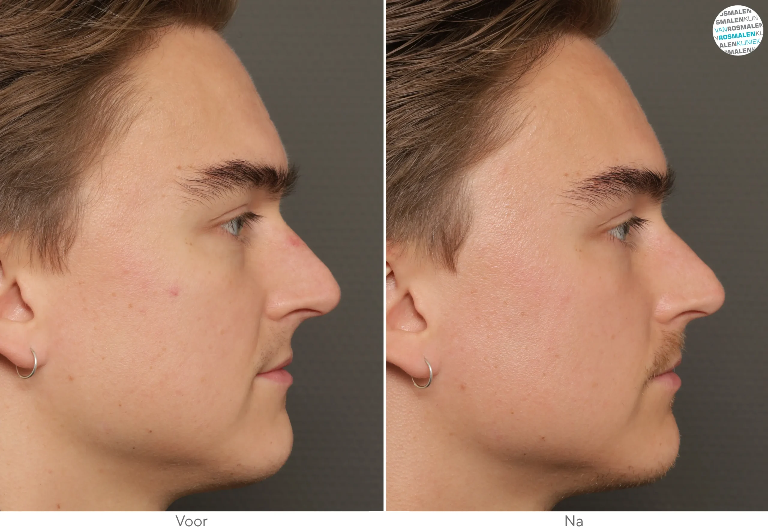 GLOW Sensitive Couperose