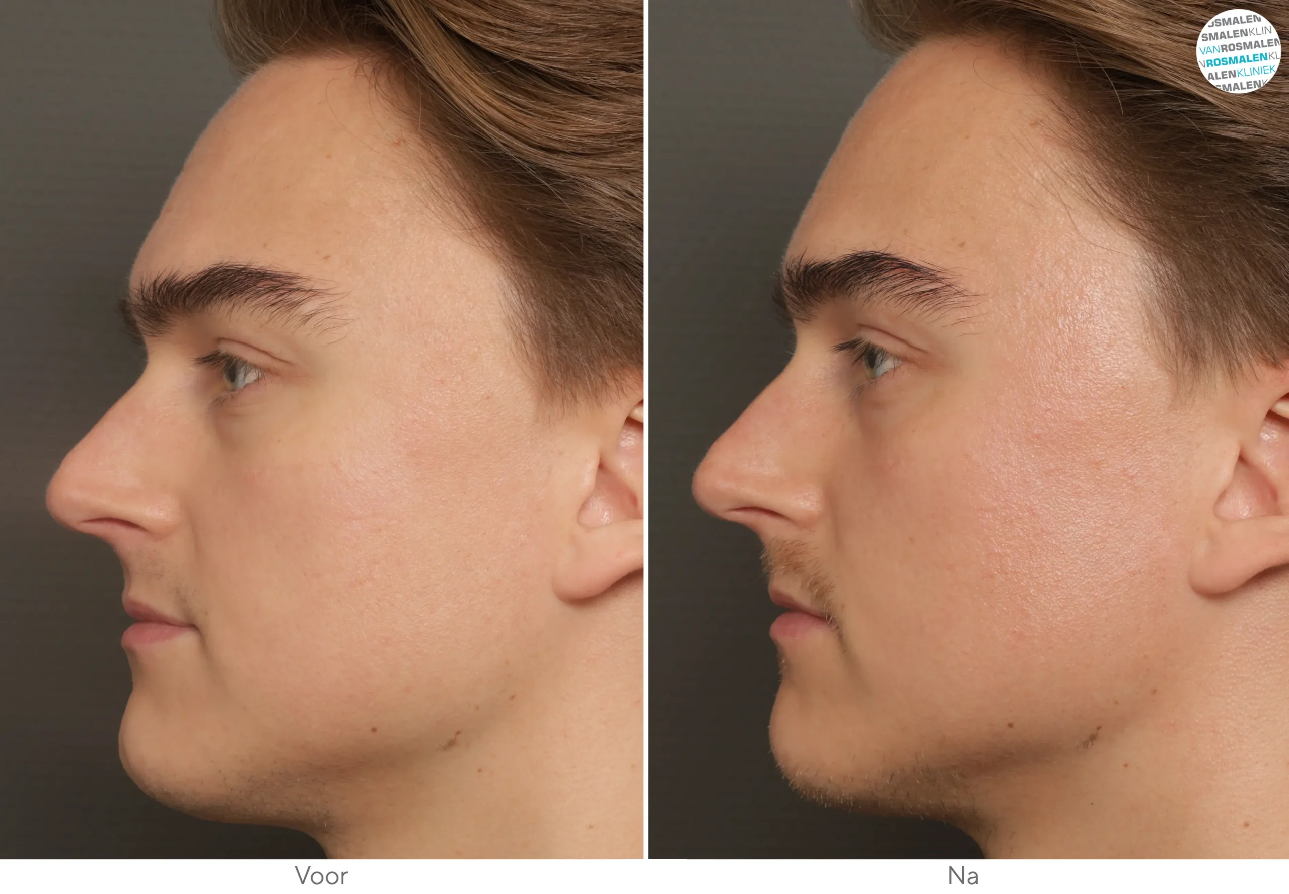 GLOW Sensitive Couperose