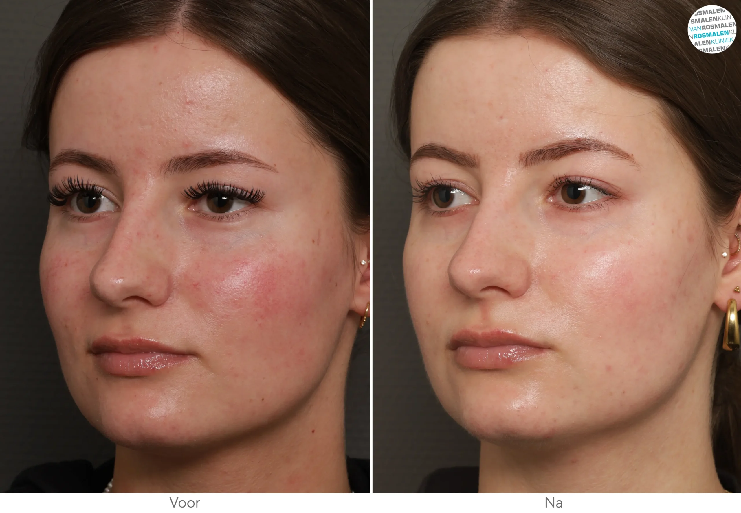 GLOW sensetive Couperose