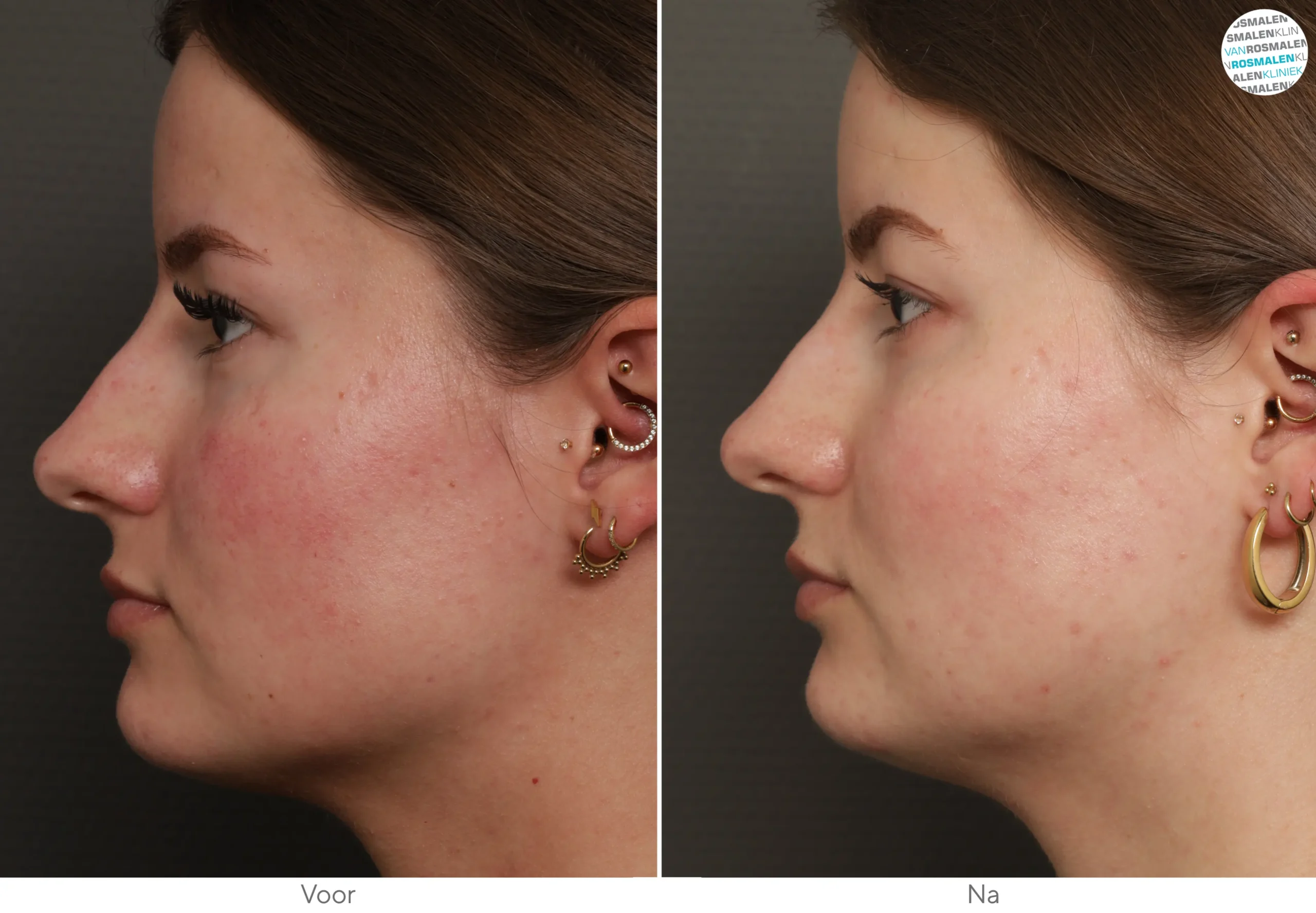 GLOW sensetive Couperose