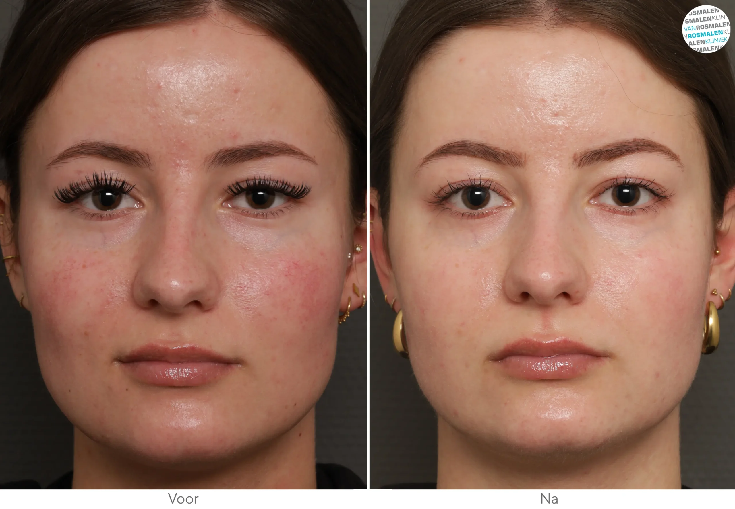 GLOW sensetive Couperose