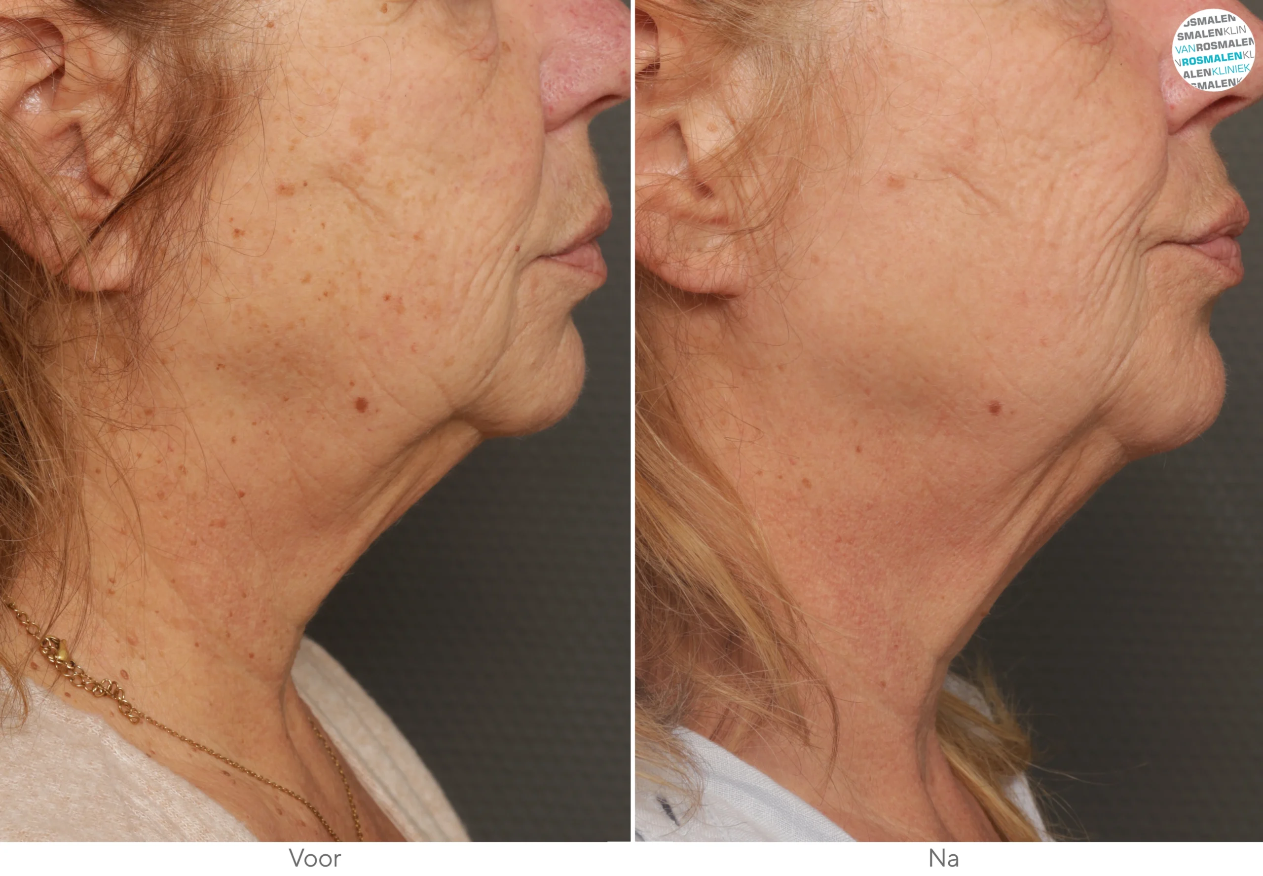 Glow Brightning couperose