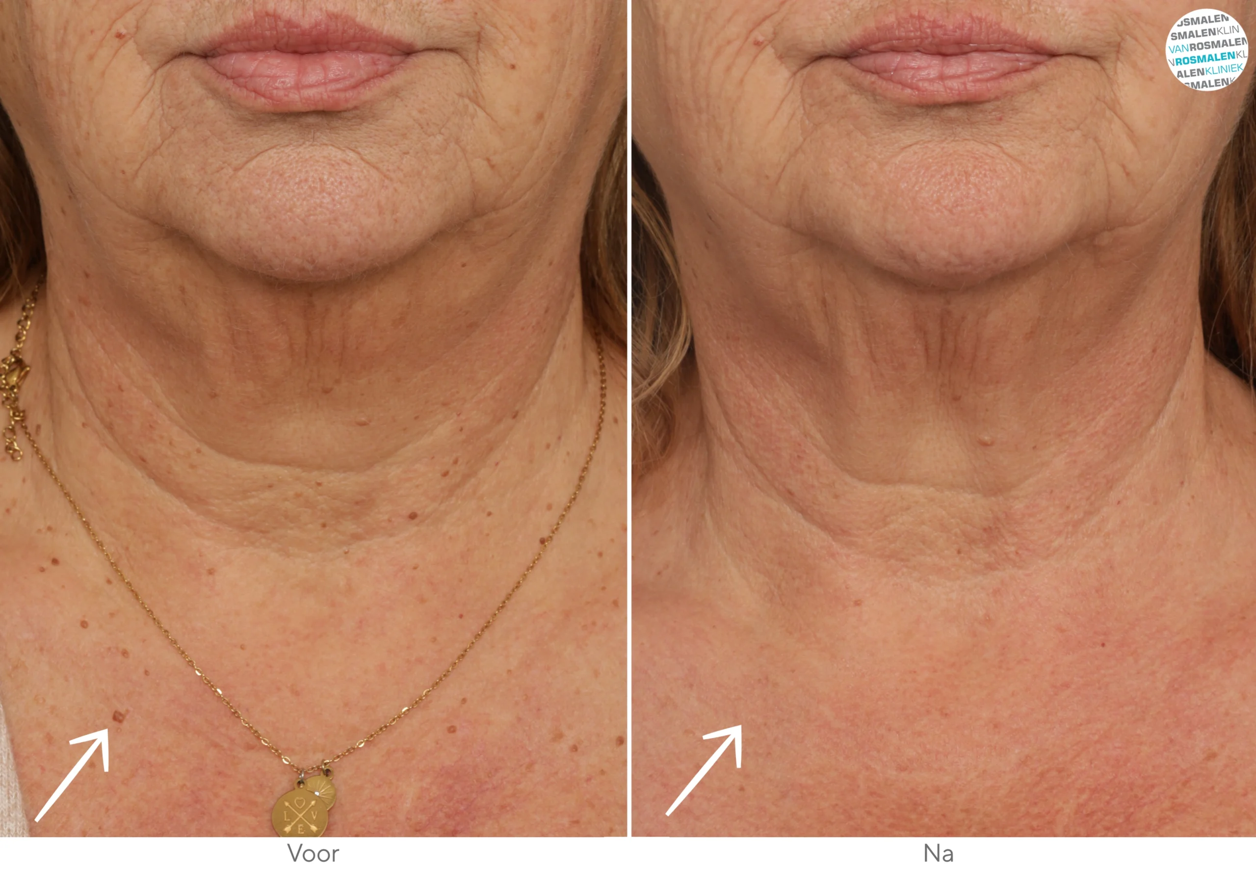 Glow Brightning couperose